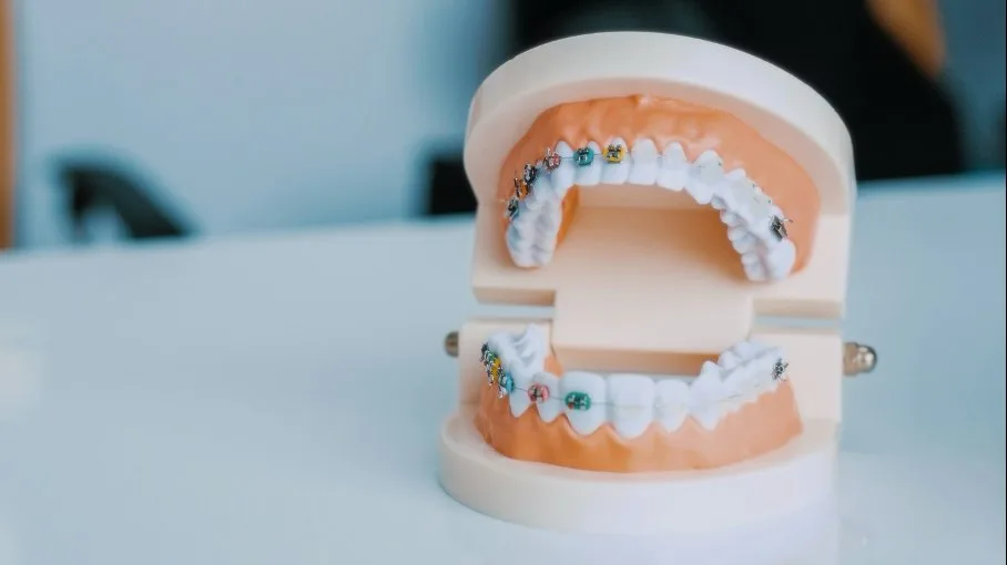 Modèle orthodontique avec appareils dentaires multi-attaches